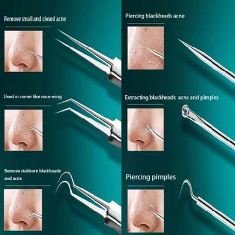 8-piece blackhead and blemish extractor tool set
